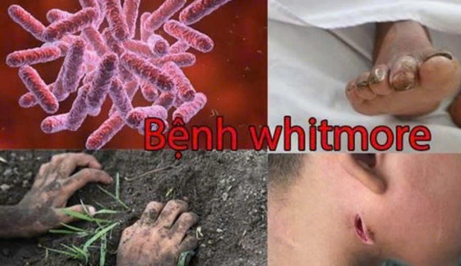 Chủ động phòng bệnh Whitmore - Bảo vệ sức khỏe cộng đồng